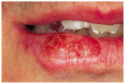 shallow mouth ulcer