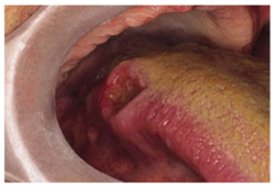 tongue cancer side of tongue