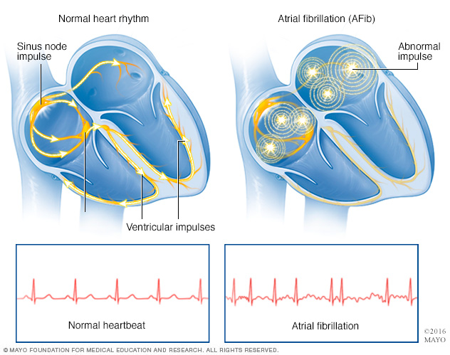Image of a heart with the text "Atrial fibrillation: an irregular and often rapid heart rate that can increase your risk of stroke and heart failure."